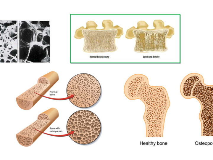 EPFL Researchers Develop Injectable Hydrogel to Rapidly Enhance Bone Density
