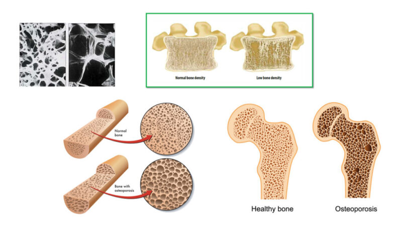 EPFL Researchers Develop Injectable Hydrogel to Rapidly Enhance Bone Density