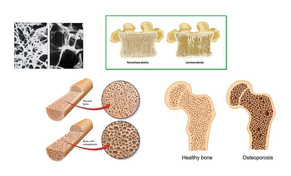 EPFL Researchers Develop Injectable Hydrogel to Rapidly Enhance Bone Density